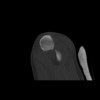 SPORK, NICO - 22.03.1976 - 02.08.2022 - CT obere Extremität - 18:01:28